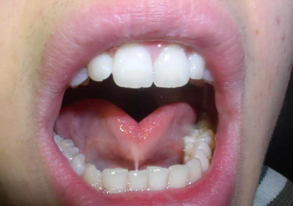Close-up photo illustrating a severe anterior tongue tie, showing the frenulum significantly restricting tongue movement.